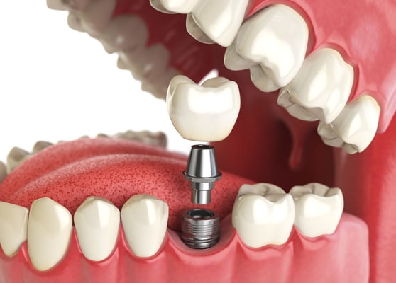 what is a dental implant min new